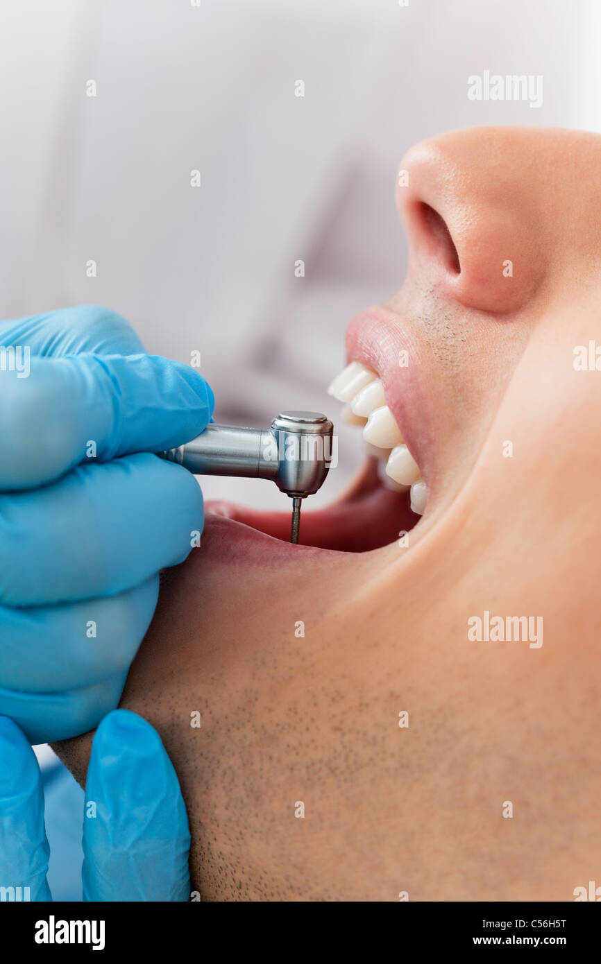 Close-up di dentista mediante trapano dentistico sui denti del paziente Foto Stock