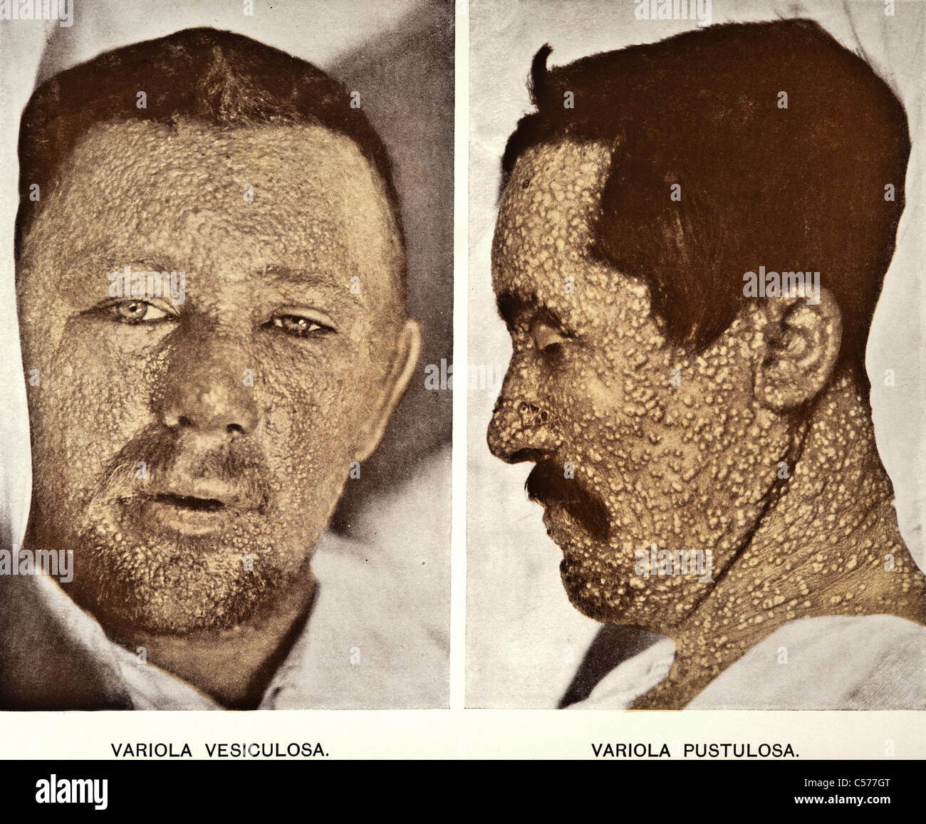Fotografia di malattia della pelle circa 1903 Foto Stock