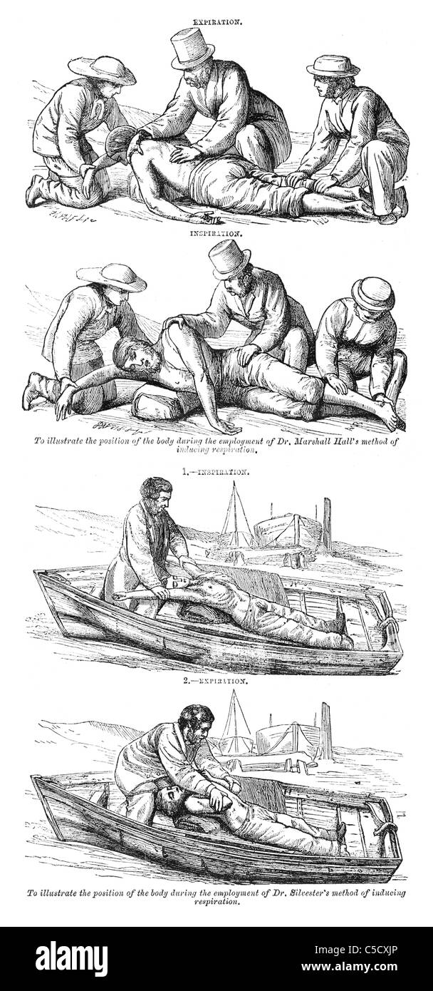 I vecchi metodi per "trattamento dell'apparentemente annegato'. Illustrazione da una rivista inglese stampato in 1864. Foto Stock