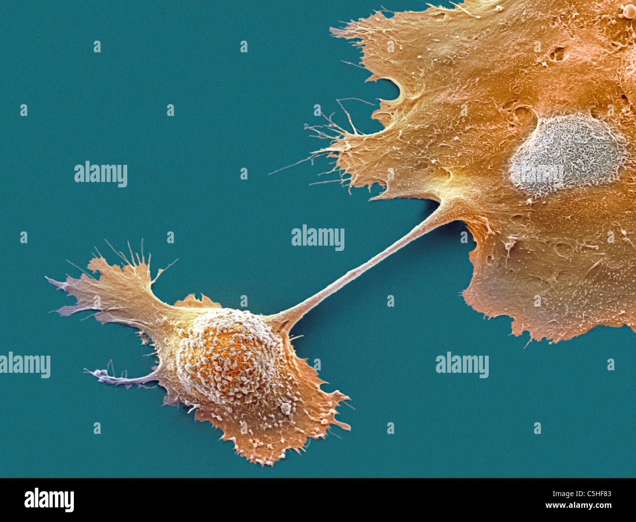 Il cancro pancreatico cellule, SEM Foto Stock