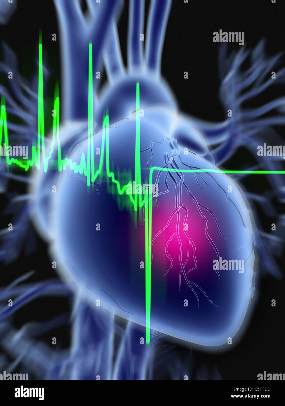 Un attacco di cuore e tracciato ECG Foto Stock