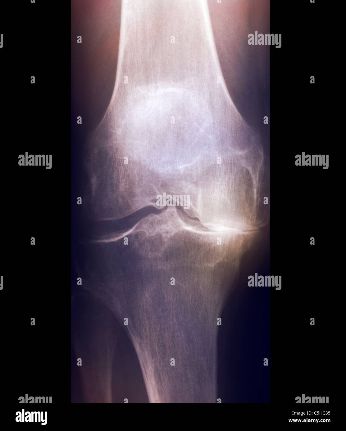 Artrosi del ginocchio, X-ray Foto Stock