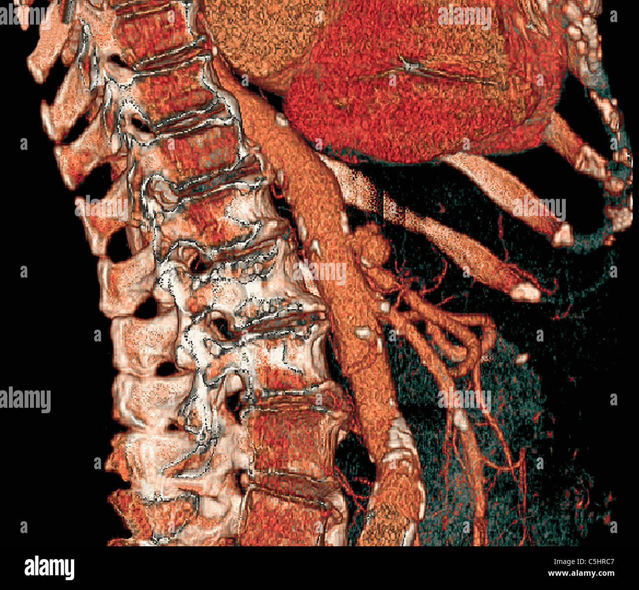 Aorta addominale e della colonna vertebrale, 3D CT scan Foto Stock