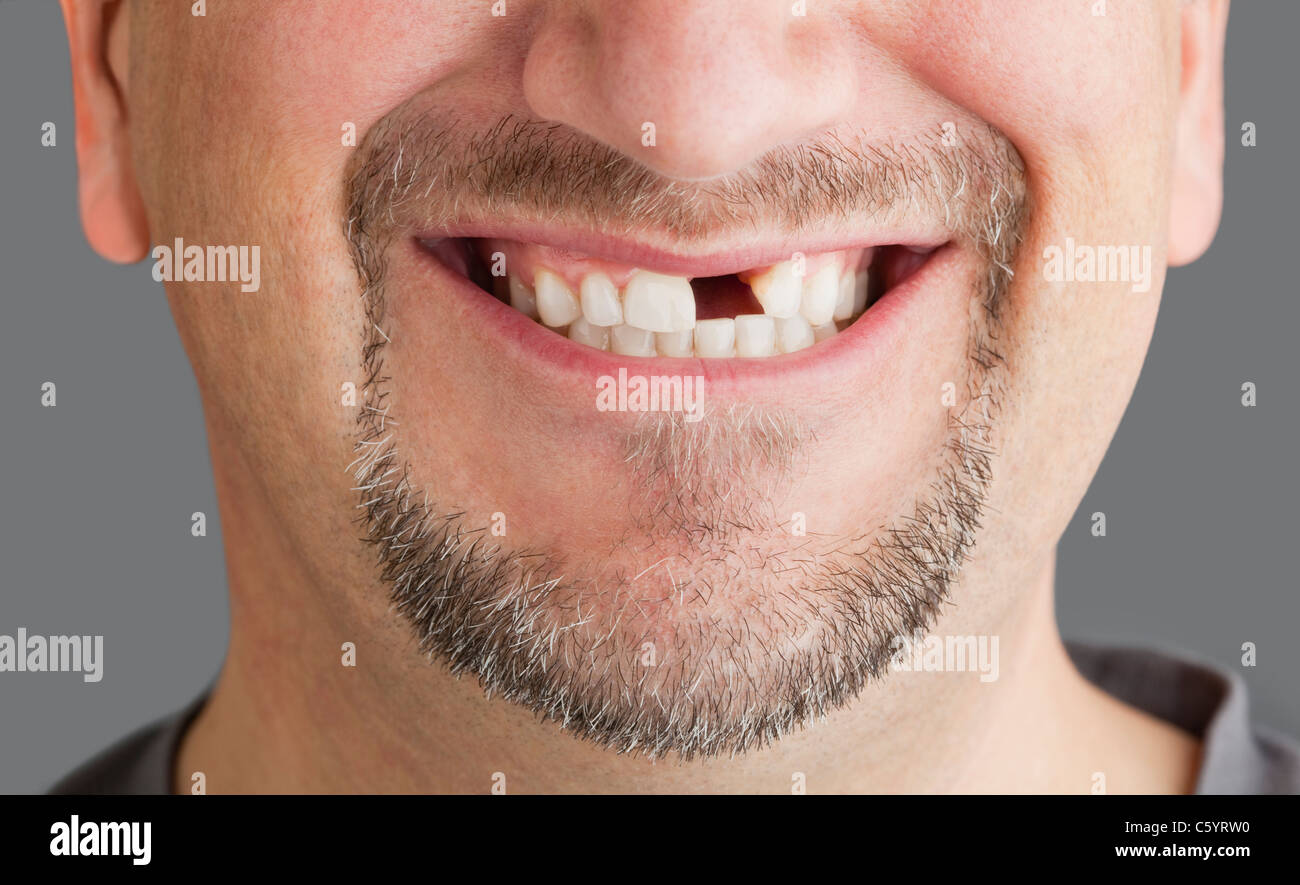 Uomo con mancante dente anteriore Foto Stock