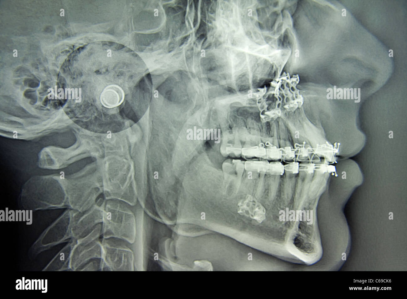 Chirurgia maxillo-facciale Foto Stock