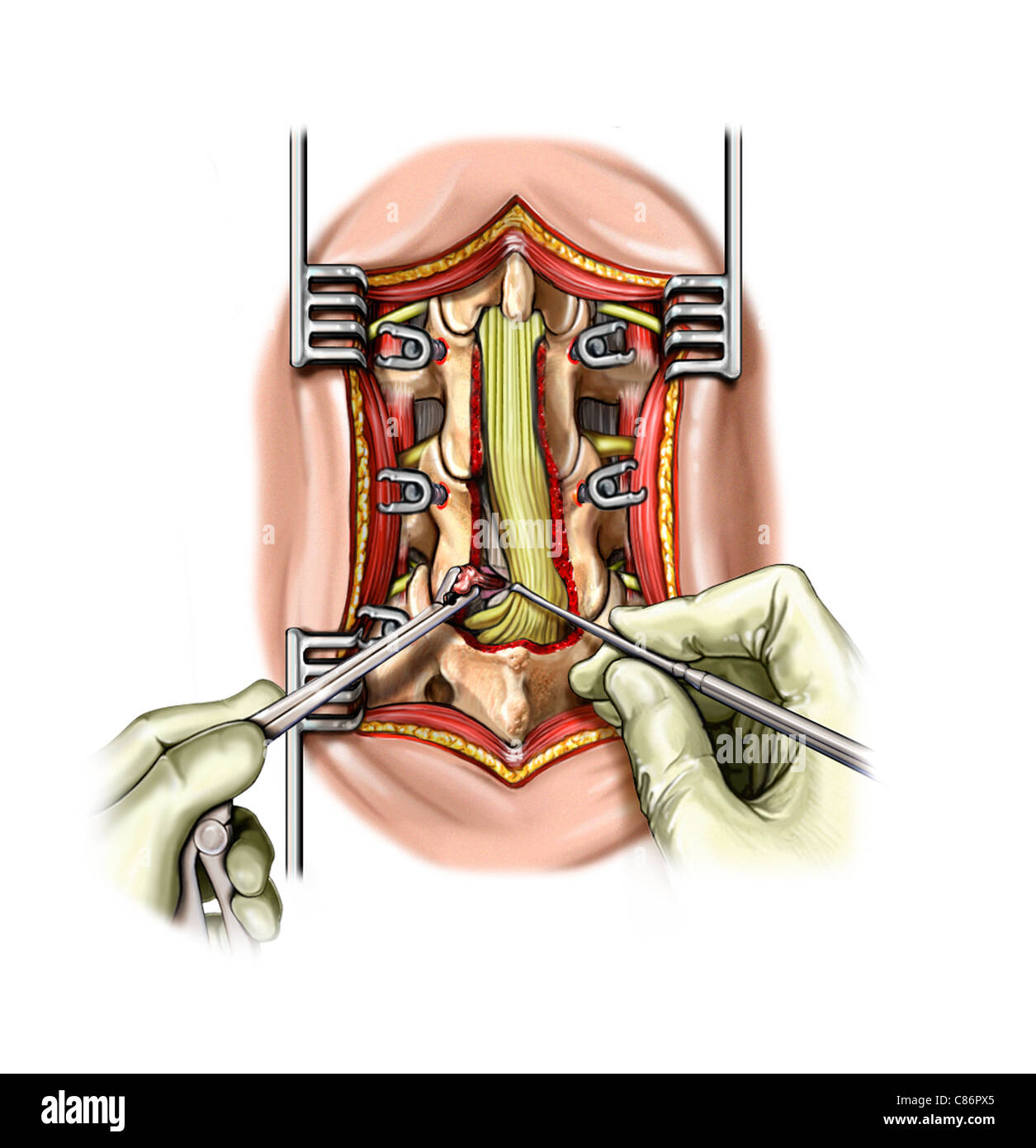 Операция удаление грыжи l5 s1. Операция удаление грыжи l5 s1. Диски l5-s1 в позвоночнике. Спинная грыжа. Секвестрированная грыжа диска.