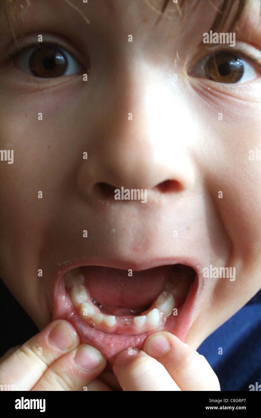 Bambino, ragazzo, denti milkteeth, dentale gap, nuovamente, dente Foto Stock