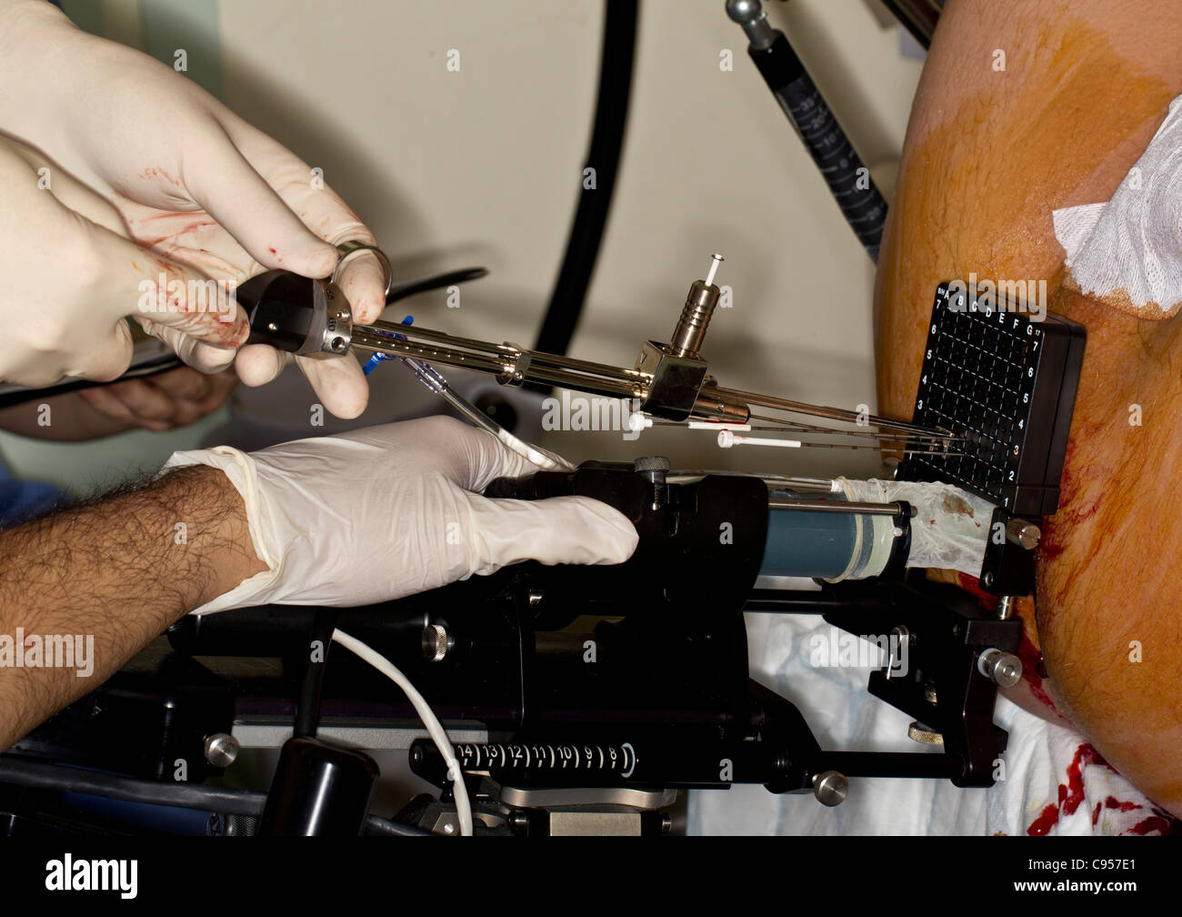 Un Mick applicatore che è utilizzata per impiantare radioioduro semi in una prostata transperineally come trattamento per il cancro della prostata Foto Stock