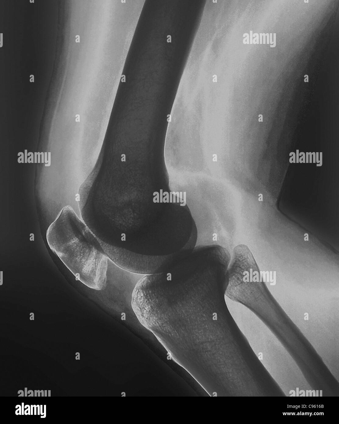Ginocchio rotti. X-ray del ginocchio di 38 anno vecchio paziente con fratturato una patella (rotula). Foto Stock