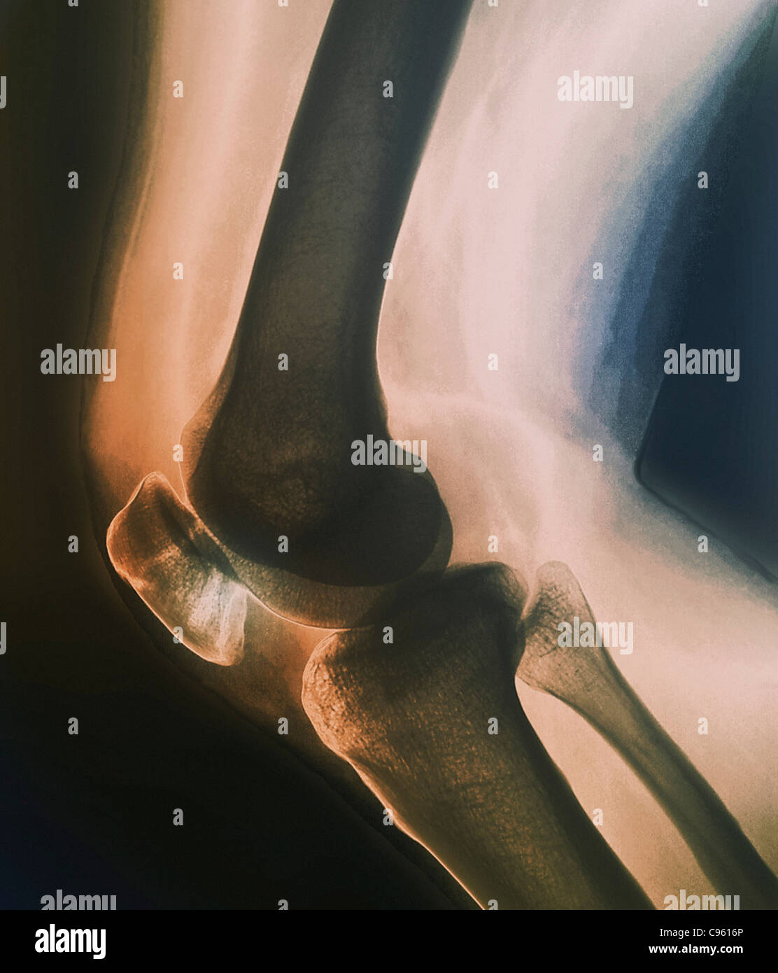 Ginocchio rotti. Colorato X-ray del ginocchio di 38 anno vecchio paziente con fratturato una patella (rotula). Foto Stock