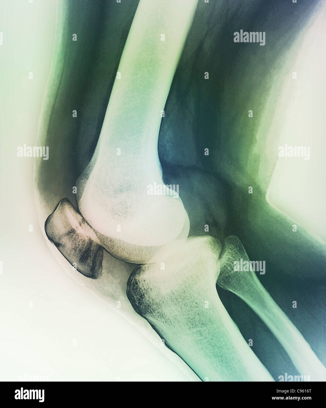 Ginocchio rotti. Colorato X-ray del ginocchio di 38 anno vecchio paziente con fratturato una patella (rotula). Foto Stock