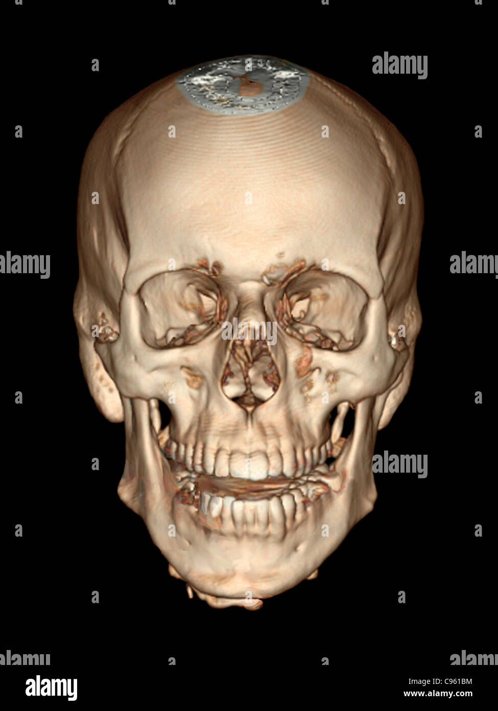 Cranio normale. Colorato 3D tomografia computerizzata (CT) Scansione del cranio sano di 36 anno vecchio paziente. Foto Stock