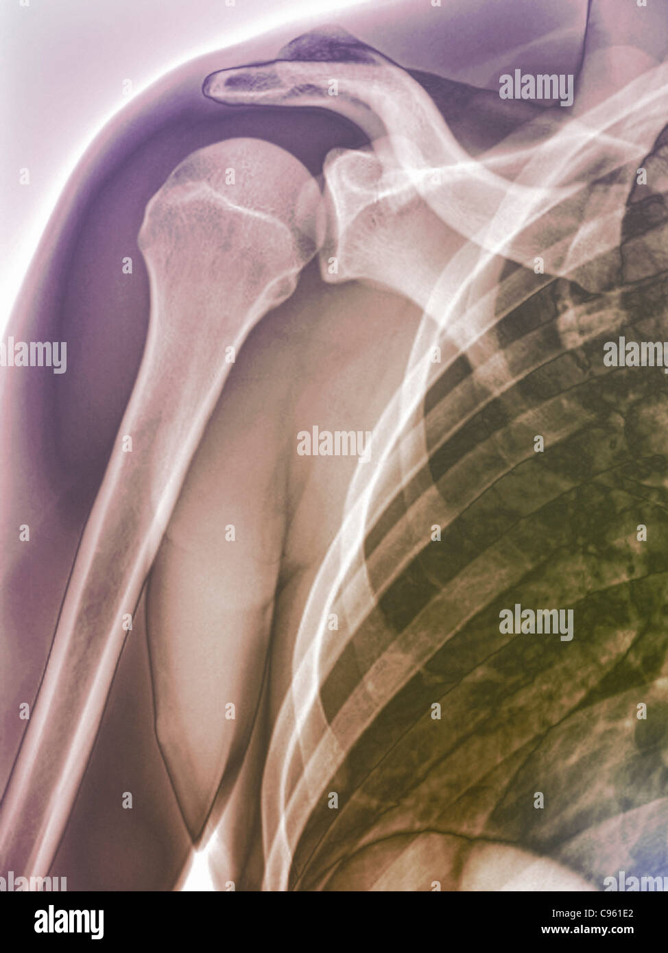 Spalla normale. Colorato X-ray dei sani spalla destra di 28 anno vecchio paziente. Foto Stock
