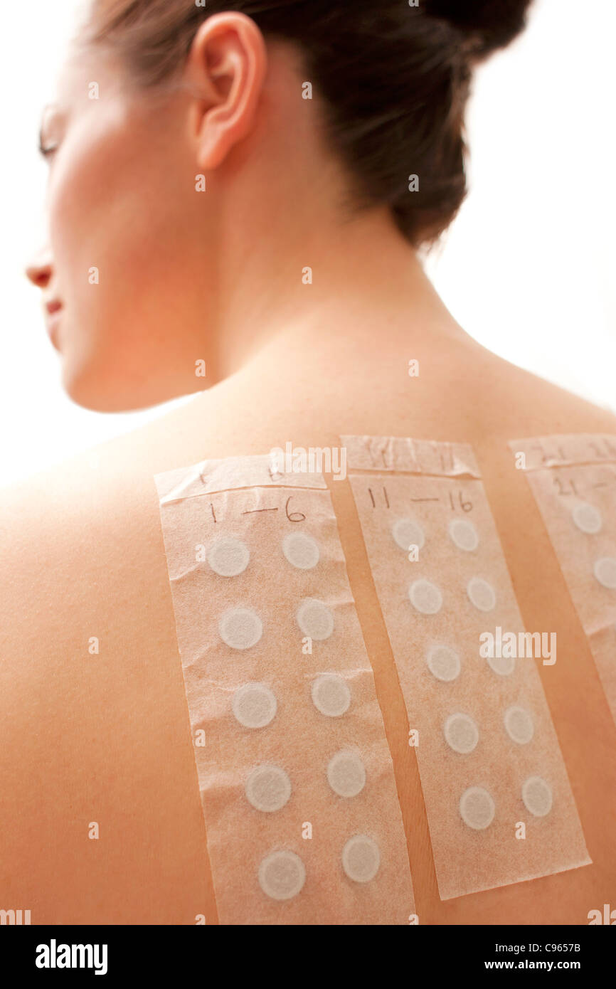 Allergia patch test. Foto Stock