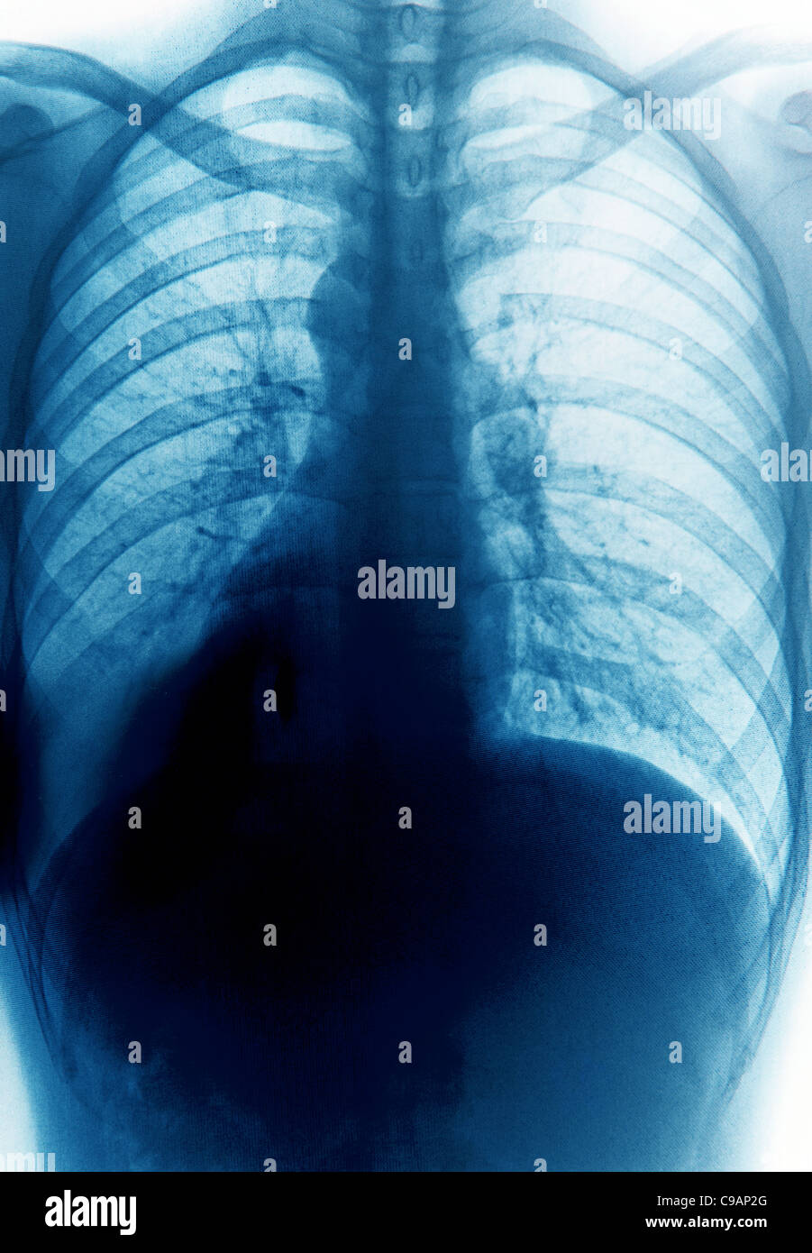 X-ray petto di osso umano Foto Stock