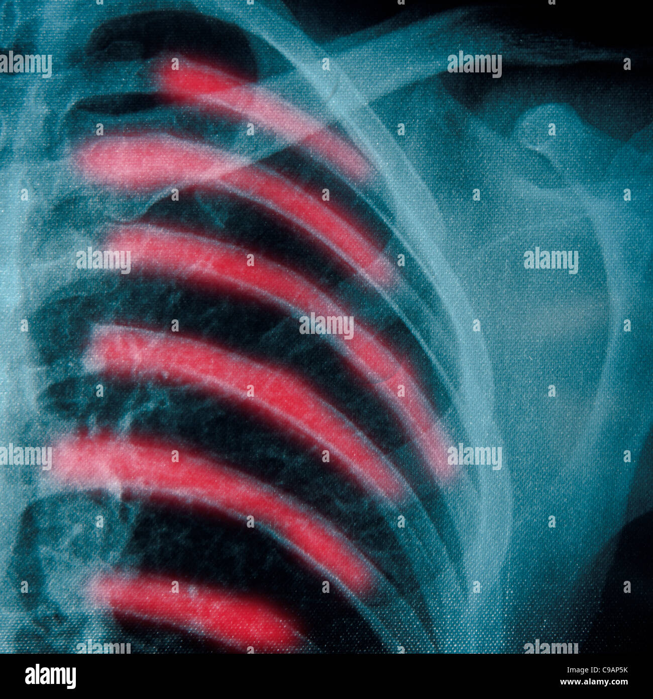 X-ray petto di osso umano Foto Stock