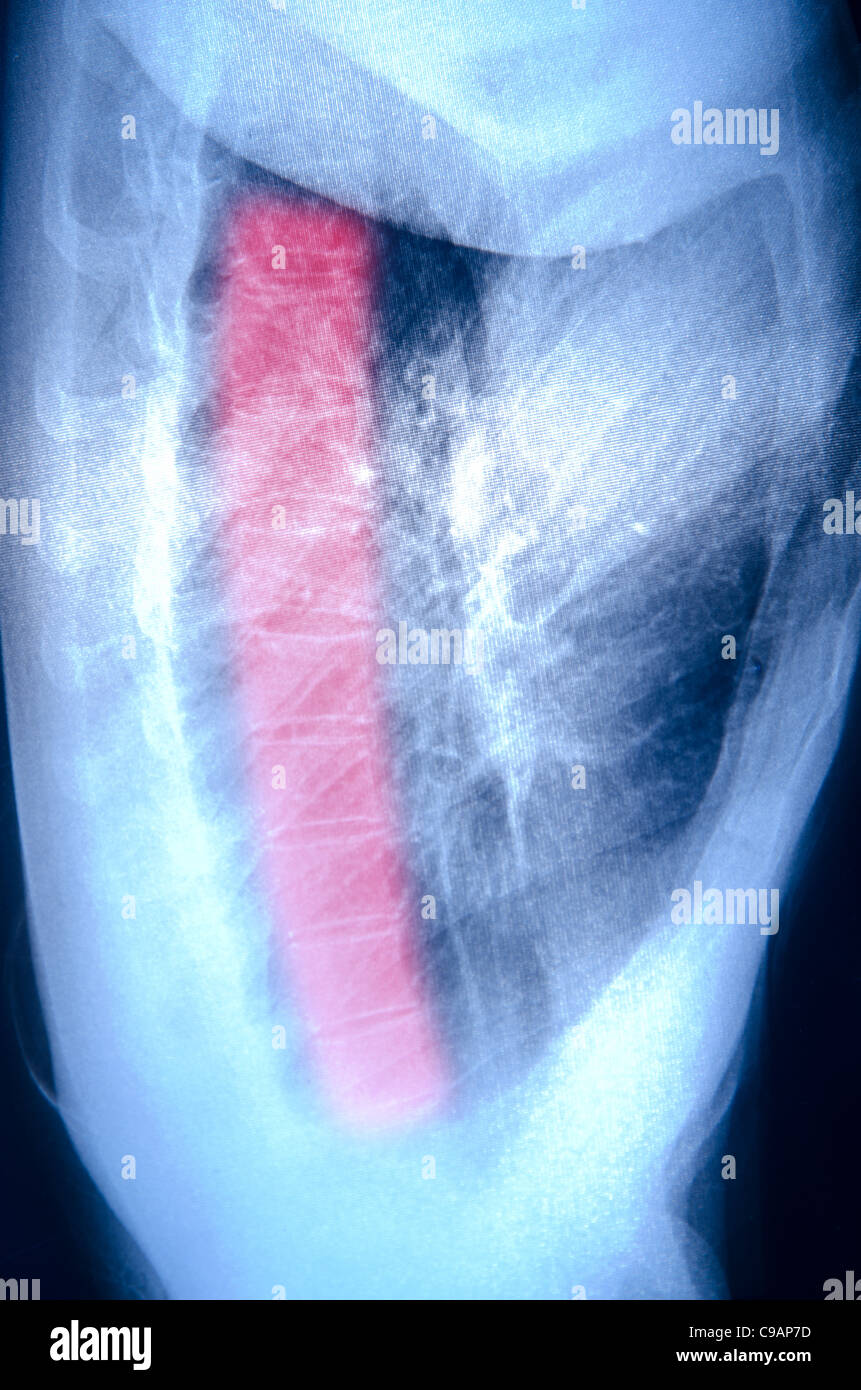 X-ray petto di osso umano Foto Stock