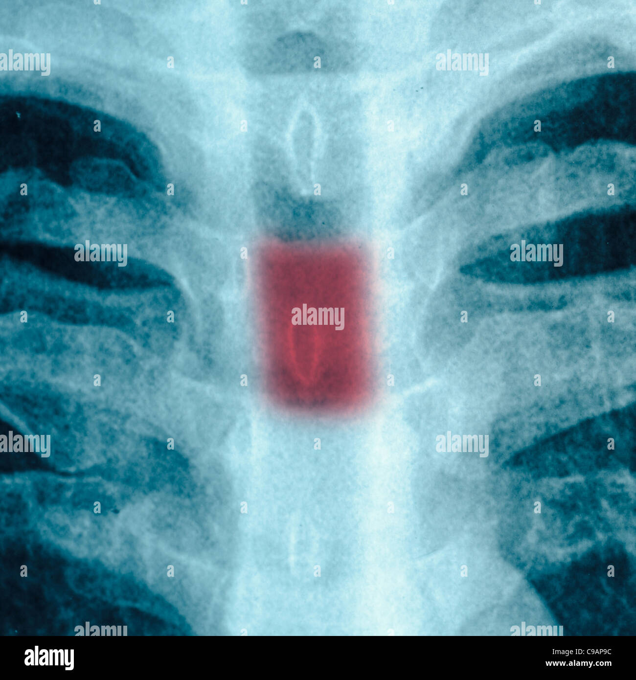 X-ray petto di osso umano Foto Stock