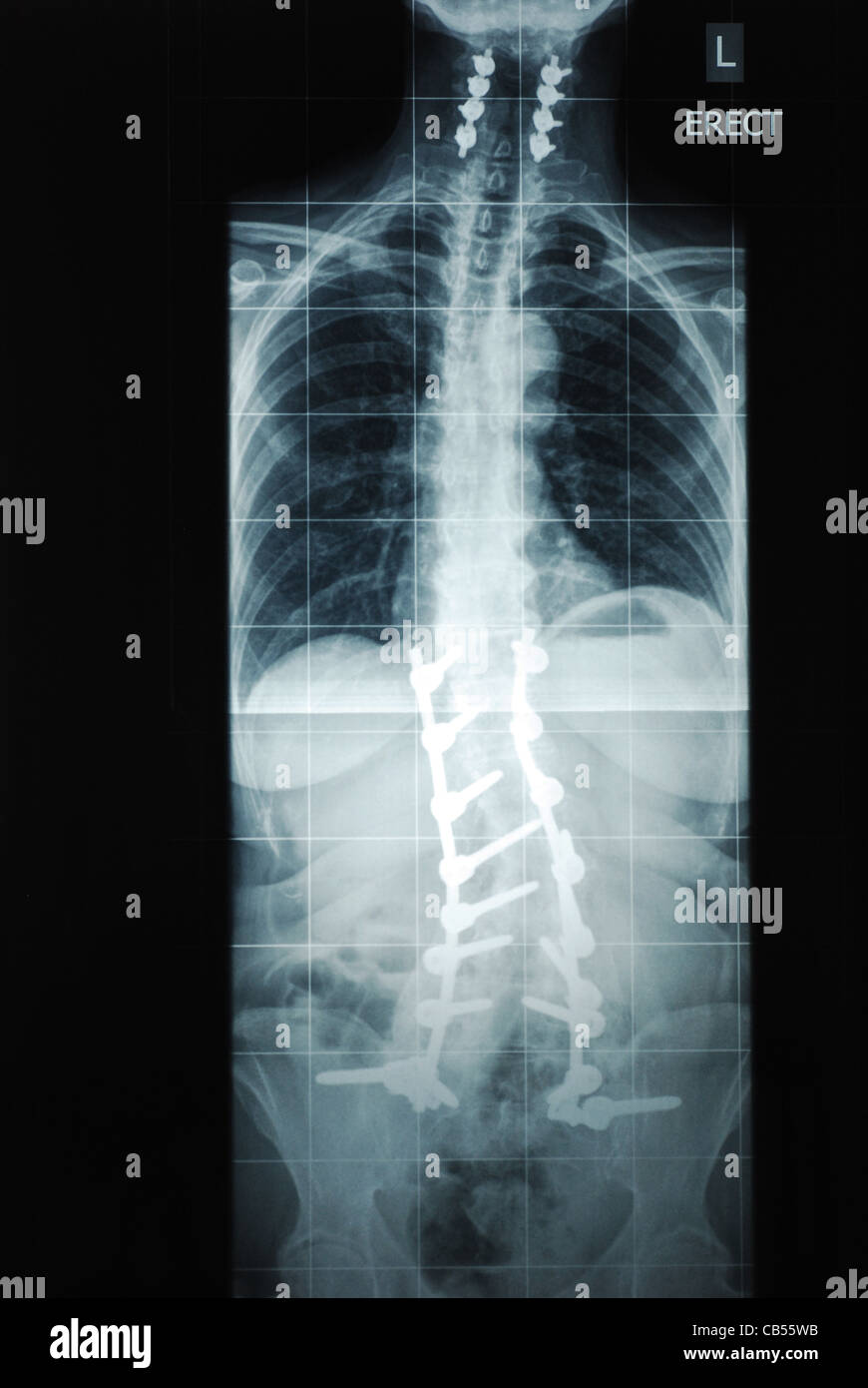 La colonna vertebrale e collo x ray con viti di supporto Foto Stock
