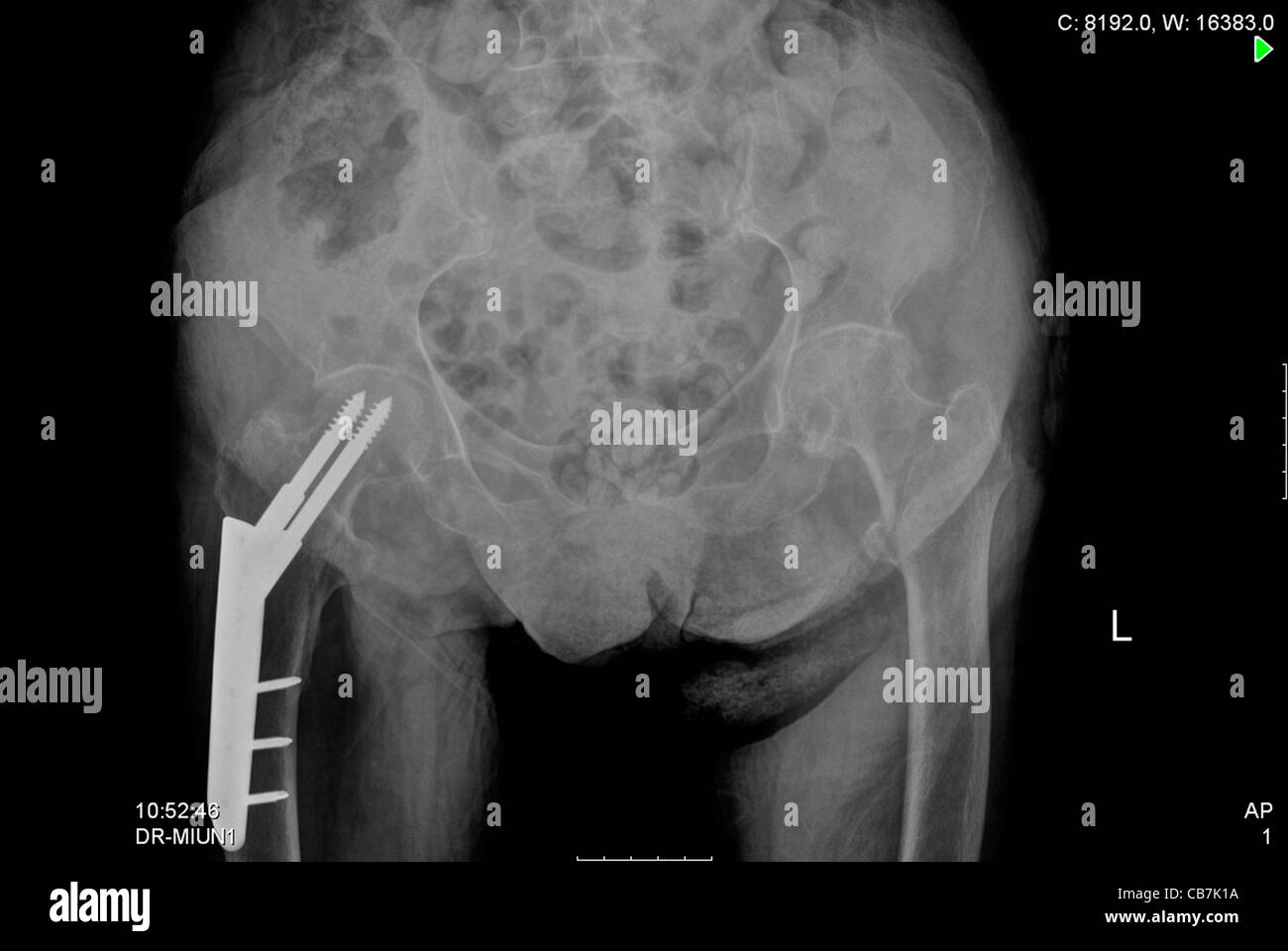 Raggi X di 93 anno vecchio paziente femmina dopo infarto acuto del miocardio (AMI), Foto Stock