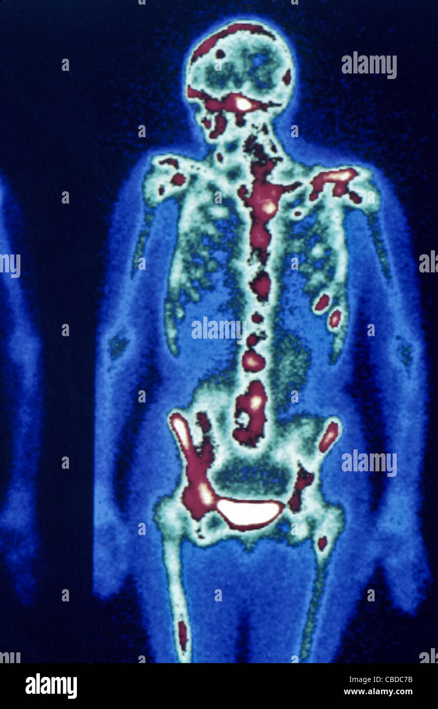 Medicina nucleare scansione ossea, più focale lesioni metastatiche sui polmoni Foto Stock