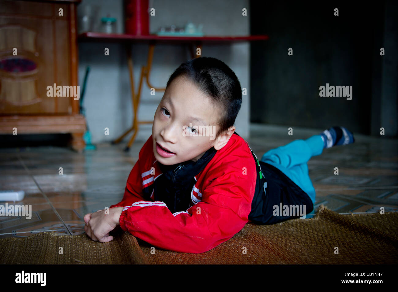 Giovane ragazzo vietnamita diagnosticato come paralisi cerebrale (CP) paziente, il risultato di una perdita di ossigeno immediatamente prima / durante la nascita. Foto Stock