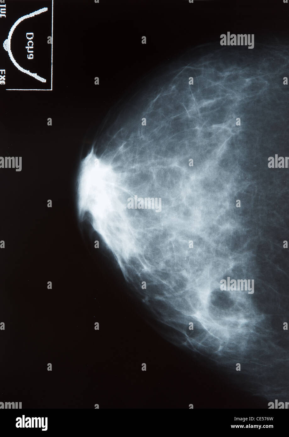 Una mammella destra per la mammografia Foto Stock