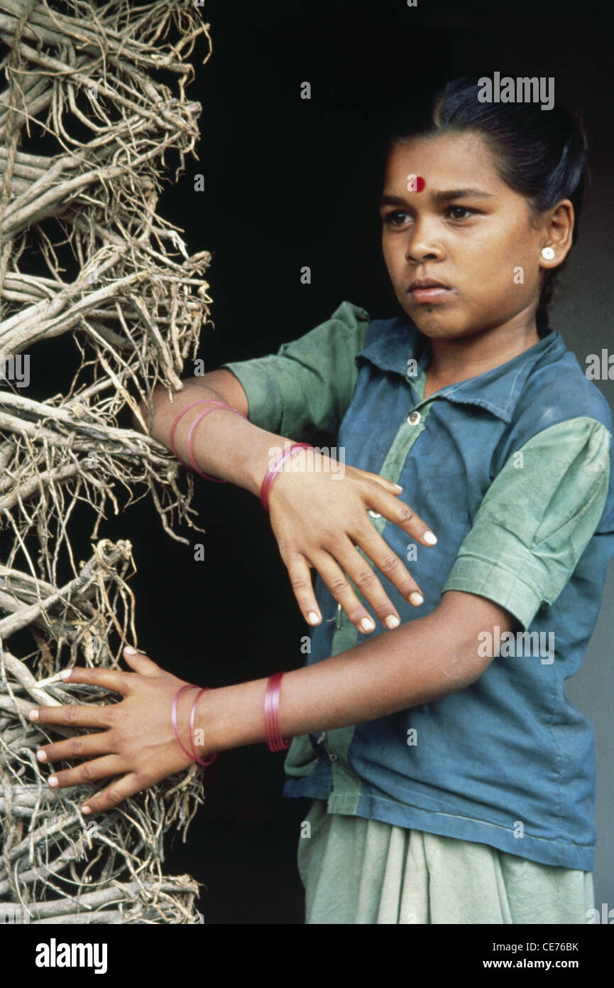 Hexadactilly ; ragazza indiana con sei dita in mano ; malformazione congenita ; Polidattilia ; polidattilismo ; iperdattilia ; India ; Asia Foto Stock