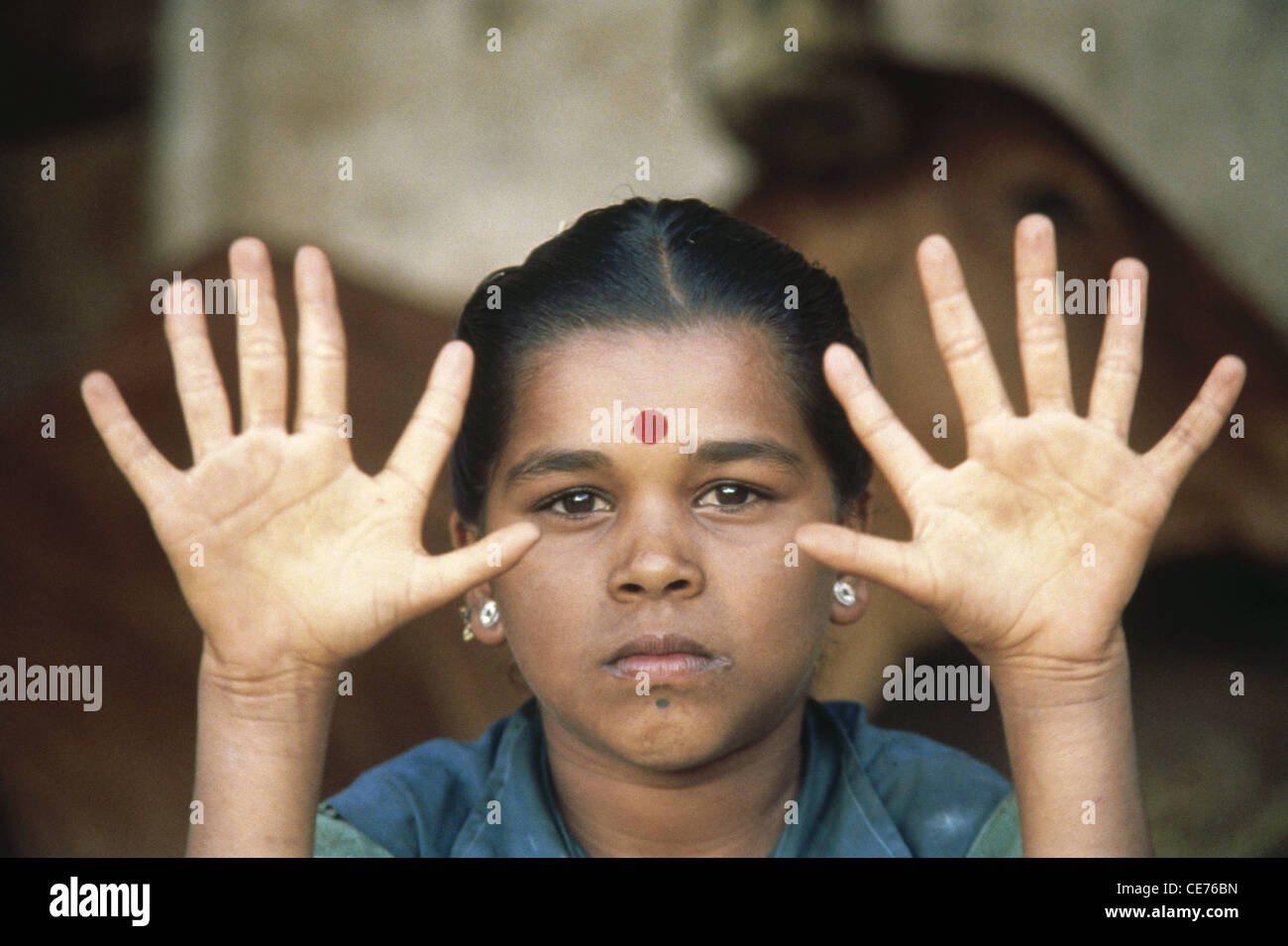 Hexadactilly ; ragazza indiana con sei dita in mano ; malformazione congenita ; Polidattilia ; polidattilismo ; iperdattilia ; India ; Asia Foto Stock