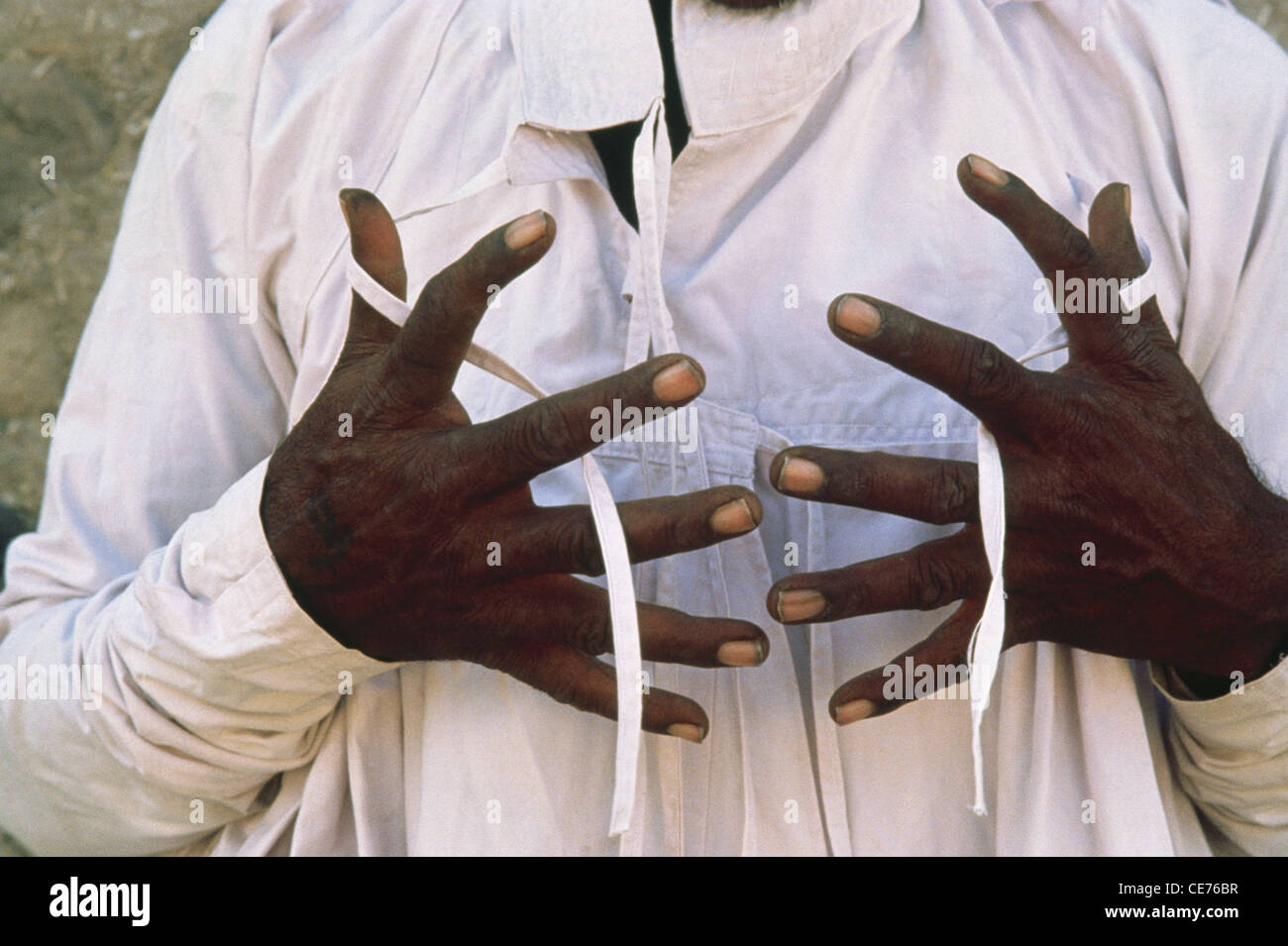 Hexadactilly ; uomo indiano con sei dita in mano ; malformazione congenita ; Polidattilo ; polidattilismo ; iperdattilismo ; India ; Asia Foto Stock