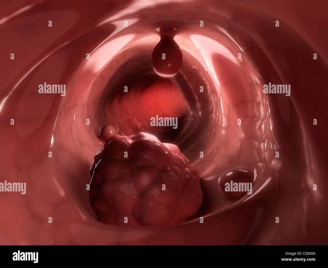 Il cancro del colon. Computer grafica di un tumore maligno (cancerose) il tumore (fondo) e polipi nel colon. Foto Stock