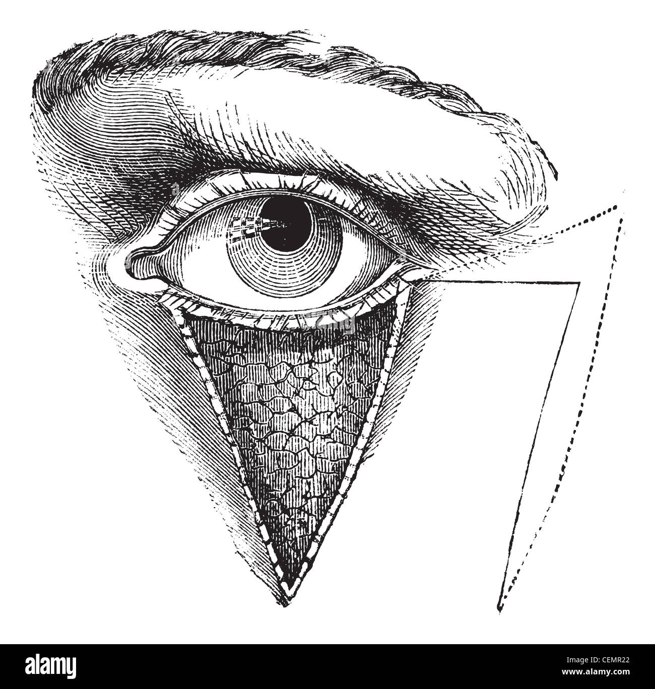 Fig. 179. della Blefaroplastica mediante il metodo di dieffembach, vintage illustrazioni incise. usuale Dizionario medicina - Paolo labarthe - 1885. Foto Stock