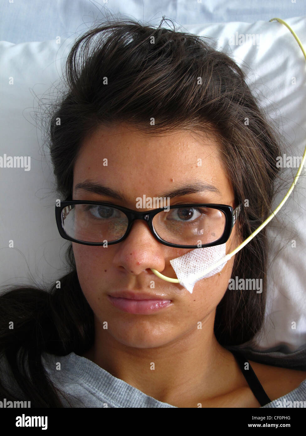 Una giovane ragazza con anoressia nervosa è trattata in ospedale da essendo alimentato nutrienti attraverso un tubo Foto Stock