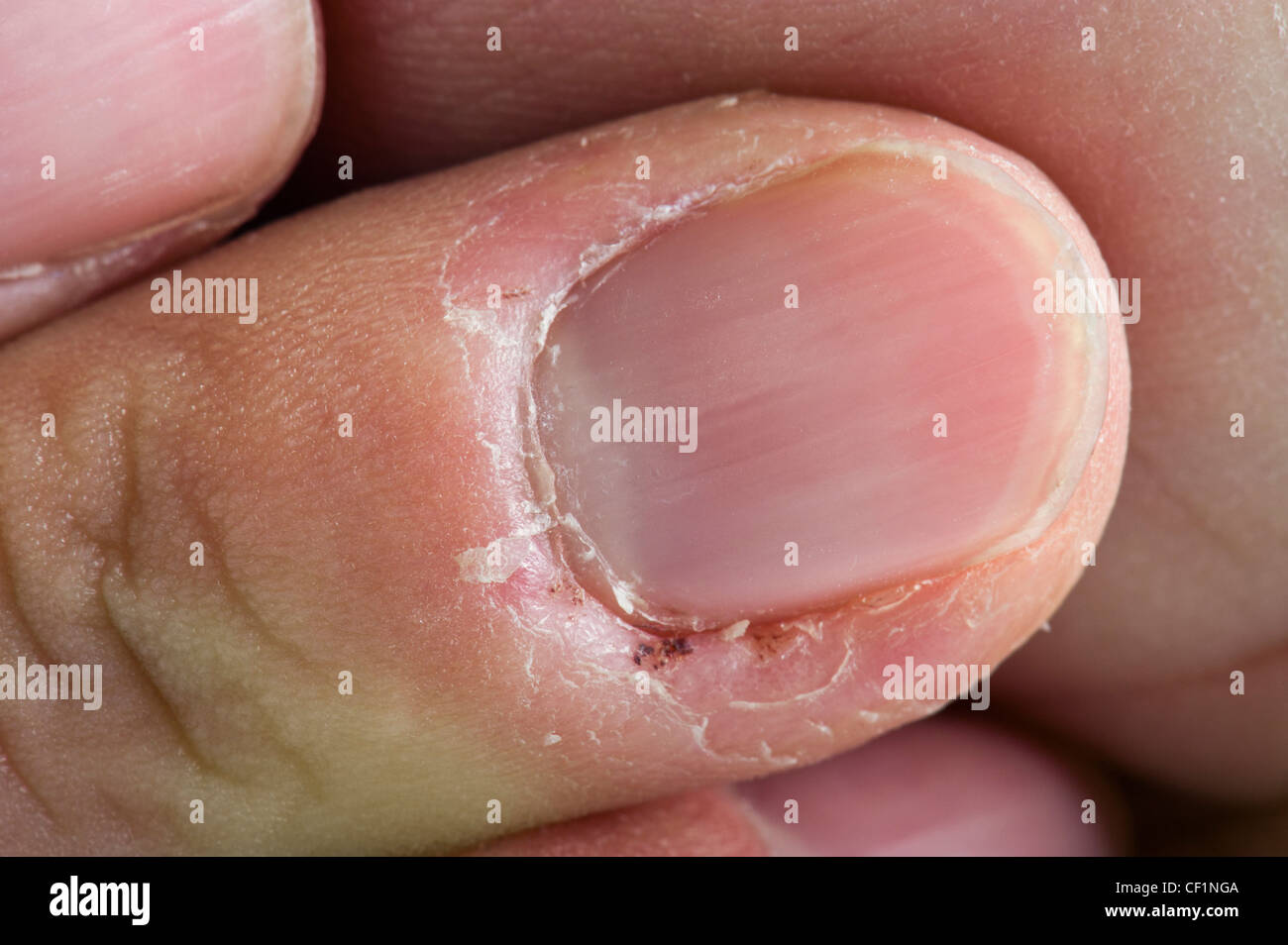 Malattia dell'unghia immagini e fotografie stock ad alta risoluzione - Alamy