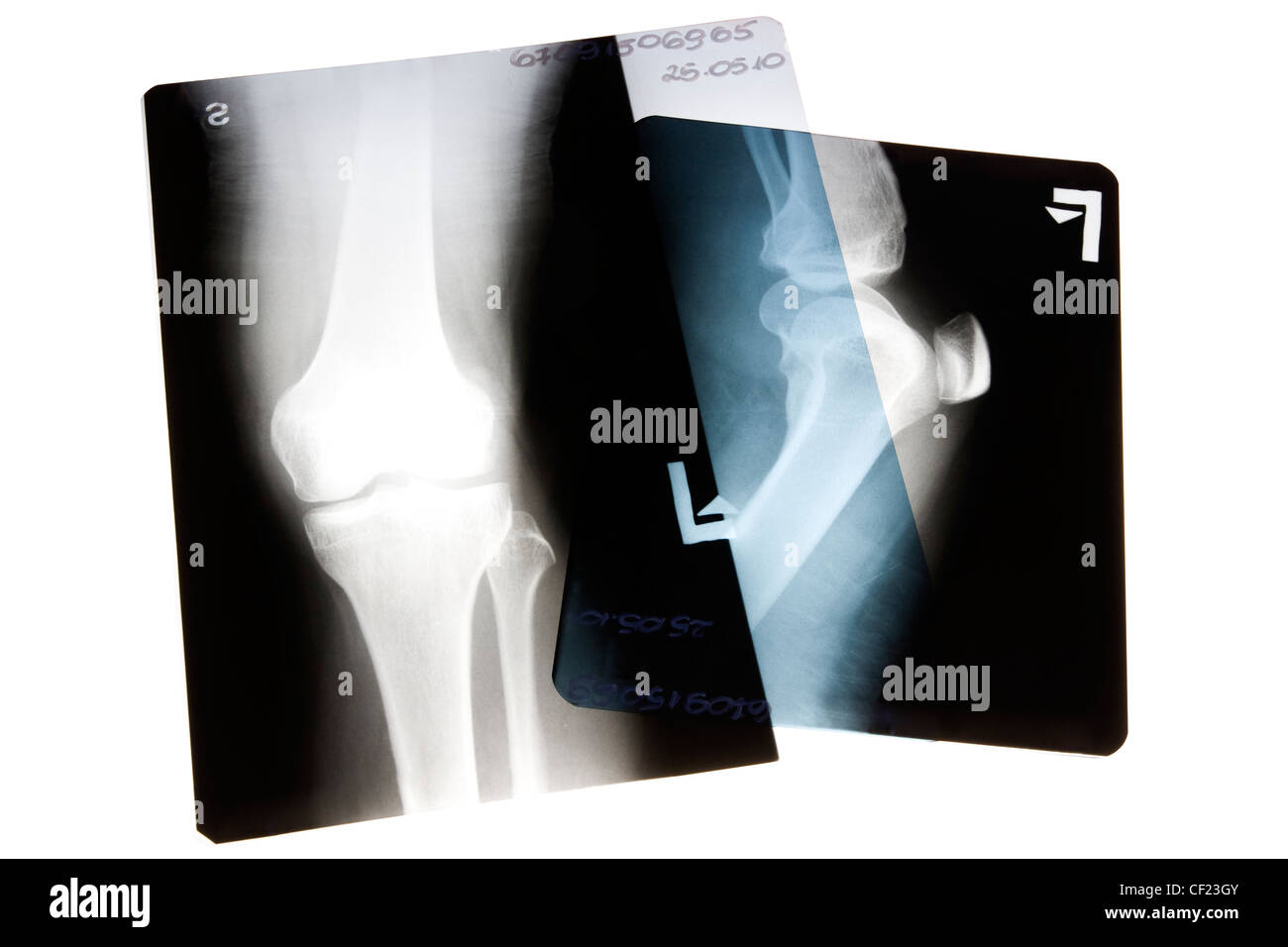 Esaminare ai raggi X la gamba e il ginocchio Foto Stock