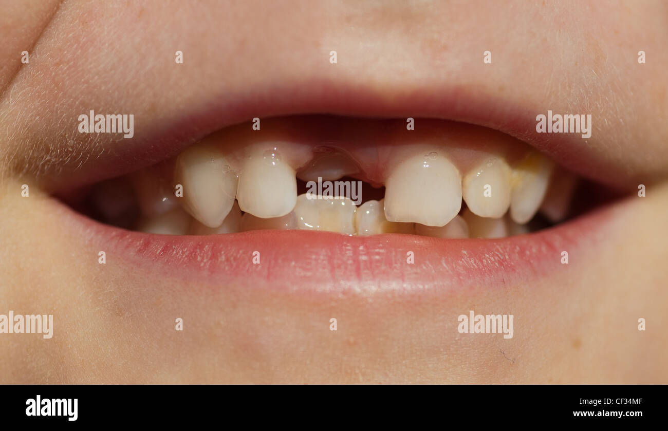 Dente di adulti provenienti attraverso la gengiva del piccolo ragazzo dove ha spinto il dente di latte fuori Foto Stock