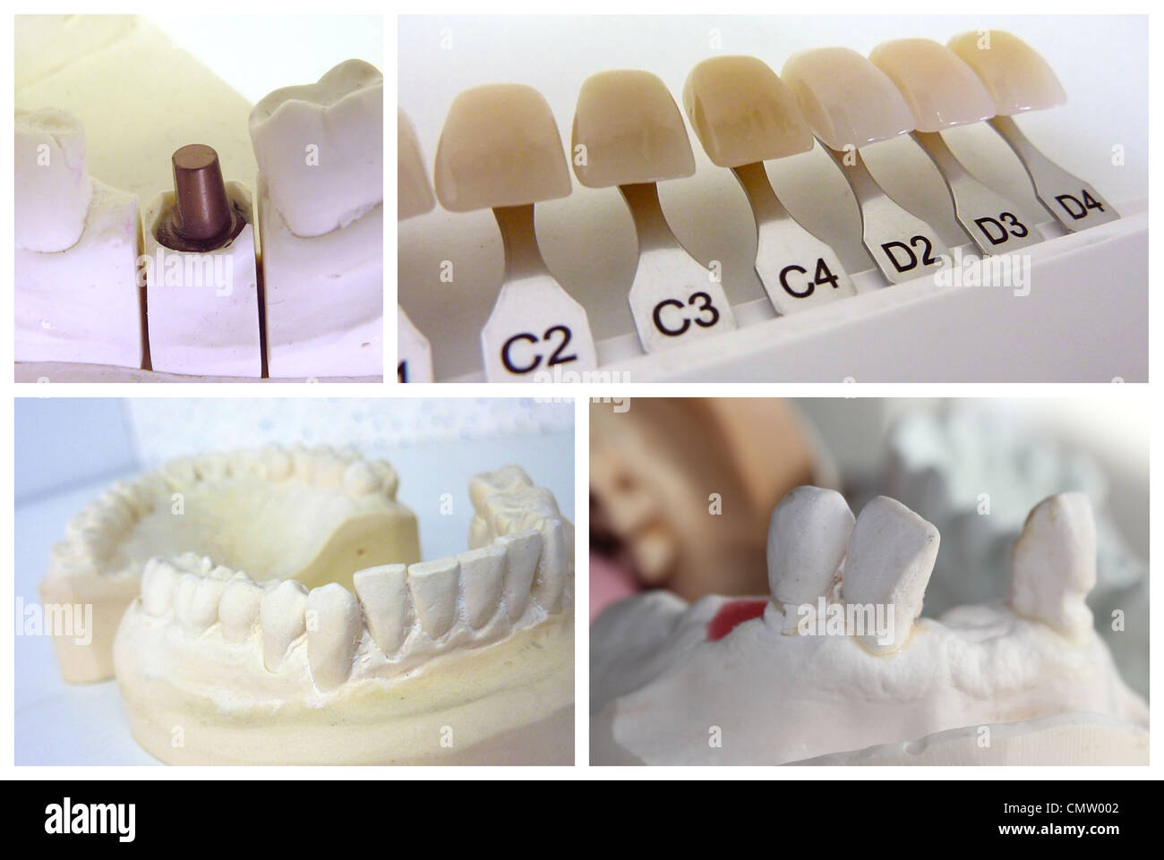Odontotecnico collage con bocca di gesso, impianto di riscontro e dentale  guida ombra Foto stock - Alamy