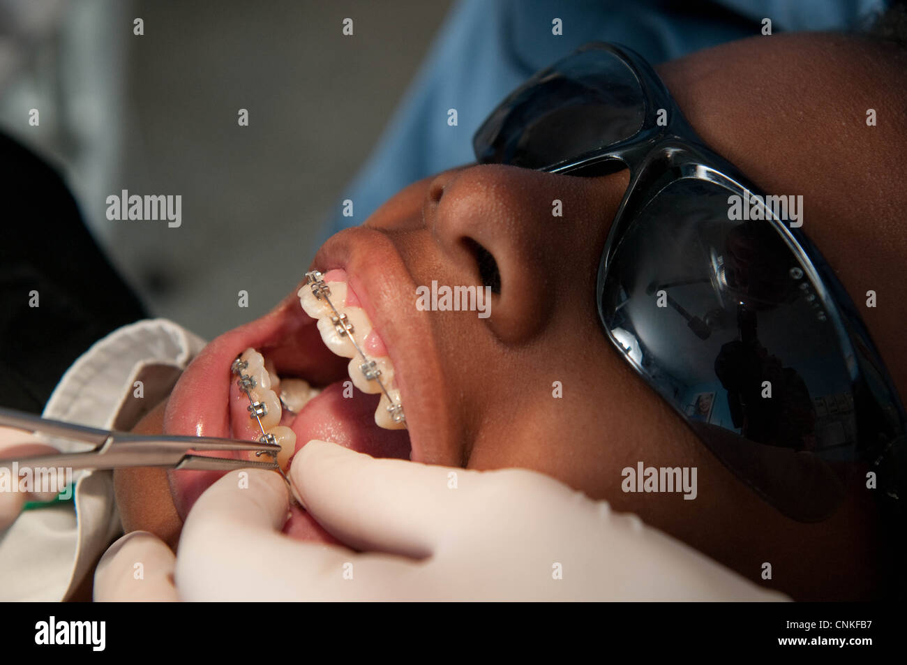 Un adolescente aventi rinforzi ortodontico dotato Foto Stock