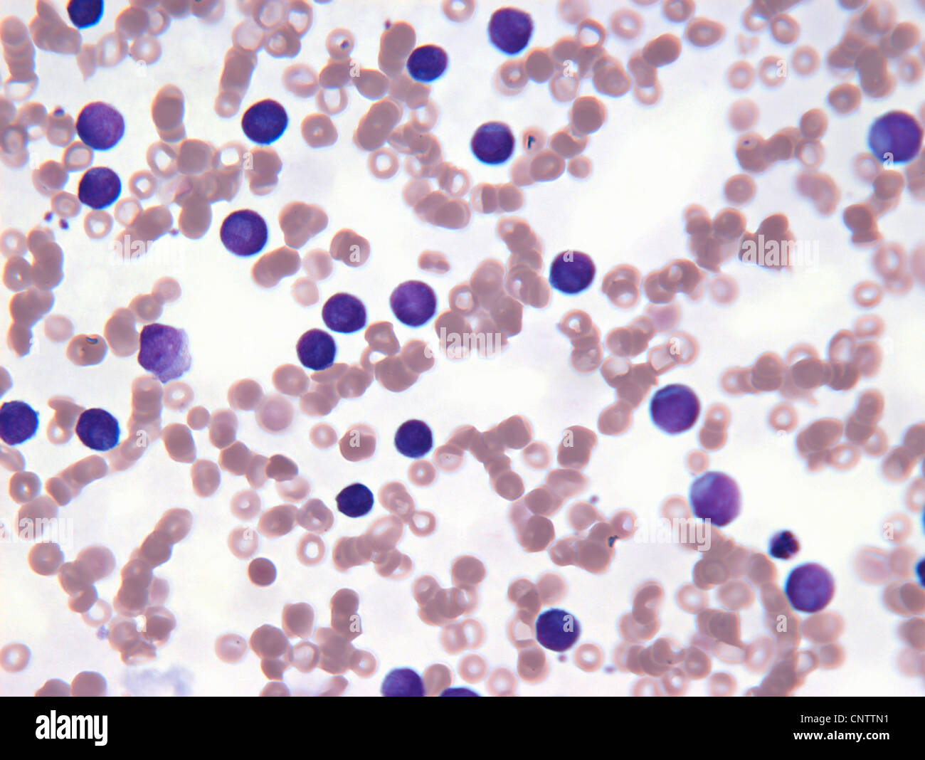 Neoplastiche di cellule linfocitarie nel sangue Foto Stock