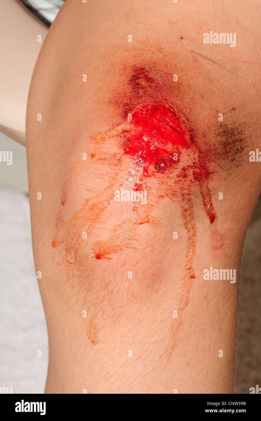 Dolori al ginocchio - bambino con abrasione Foto Stock