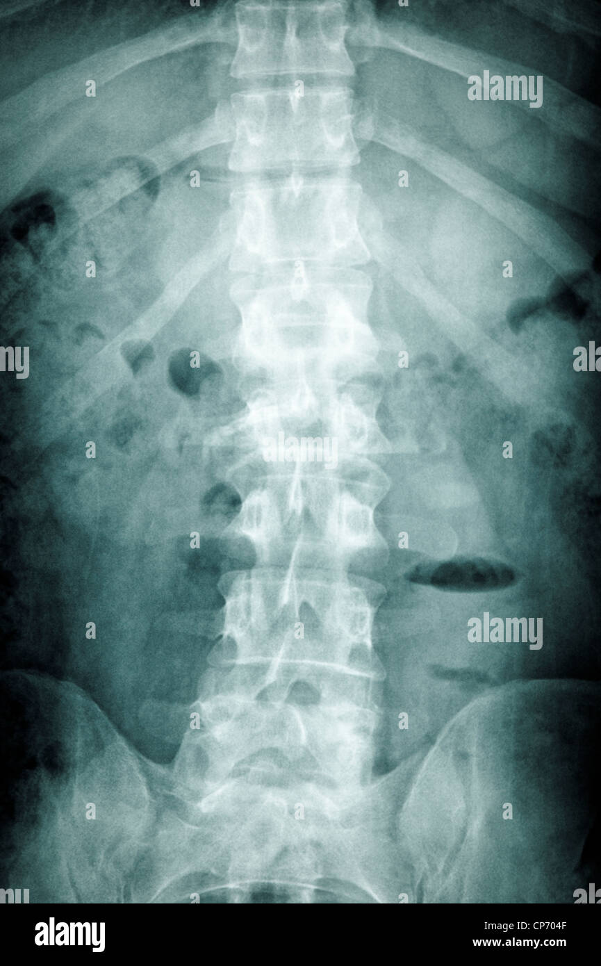 Posteriore dei raggi x Foto Stock