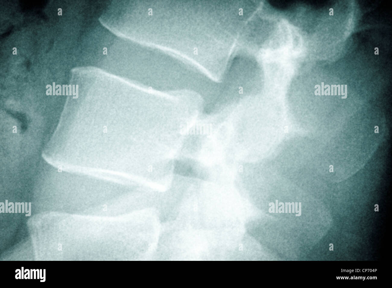 Posteriore dei raggi x Foto Stock