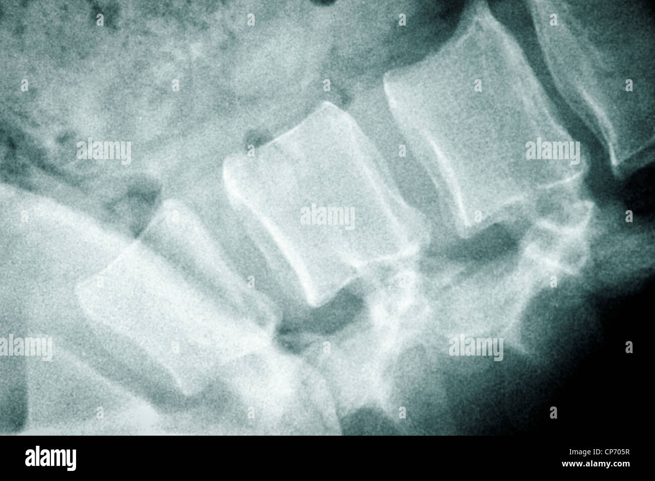 Posteriore dei raggi x Foto Stock