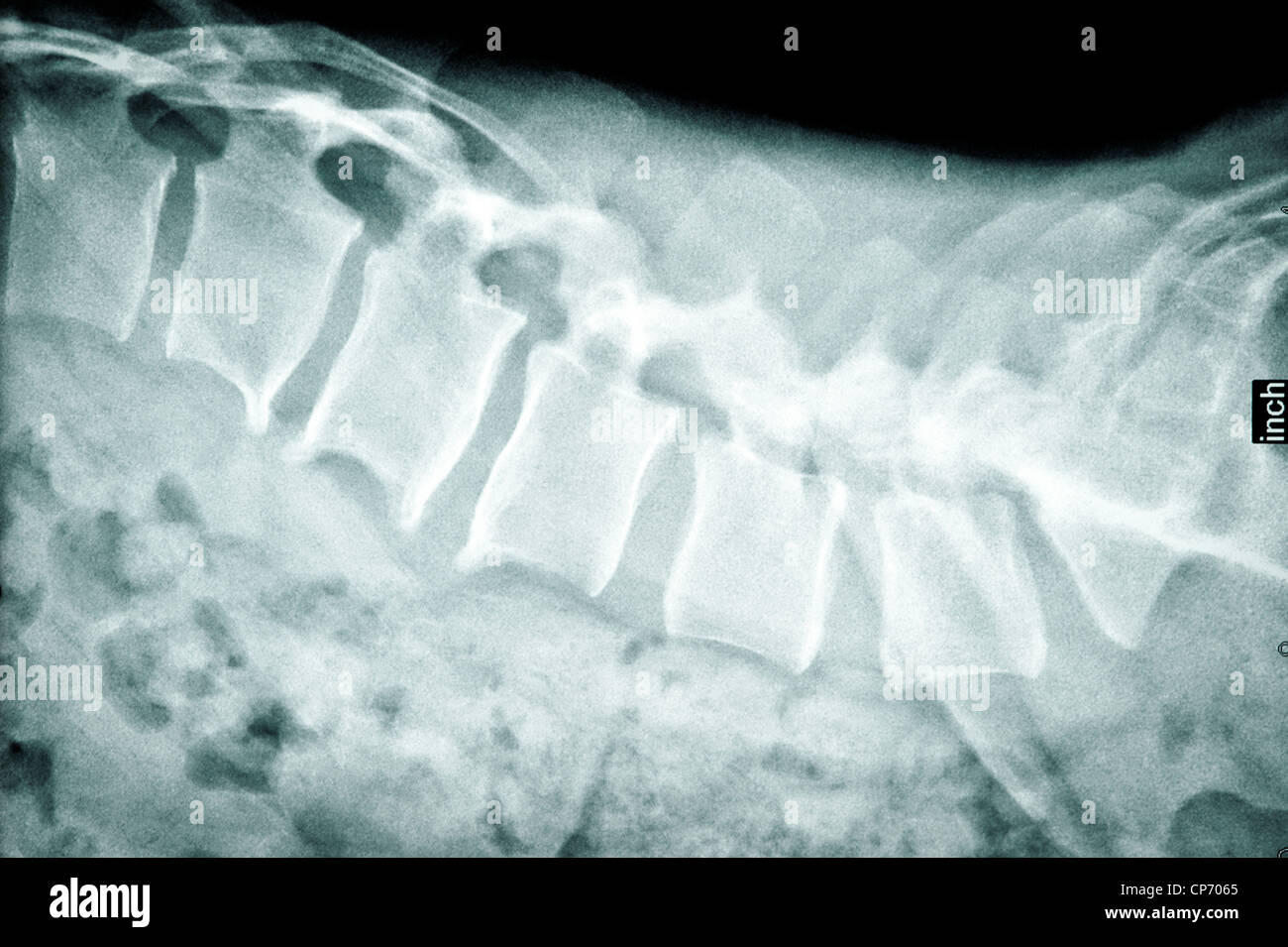 Posteriore dei raggi x Foto Stock