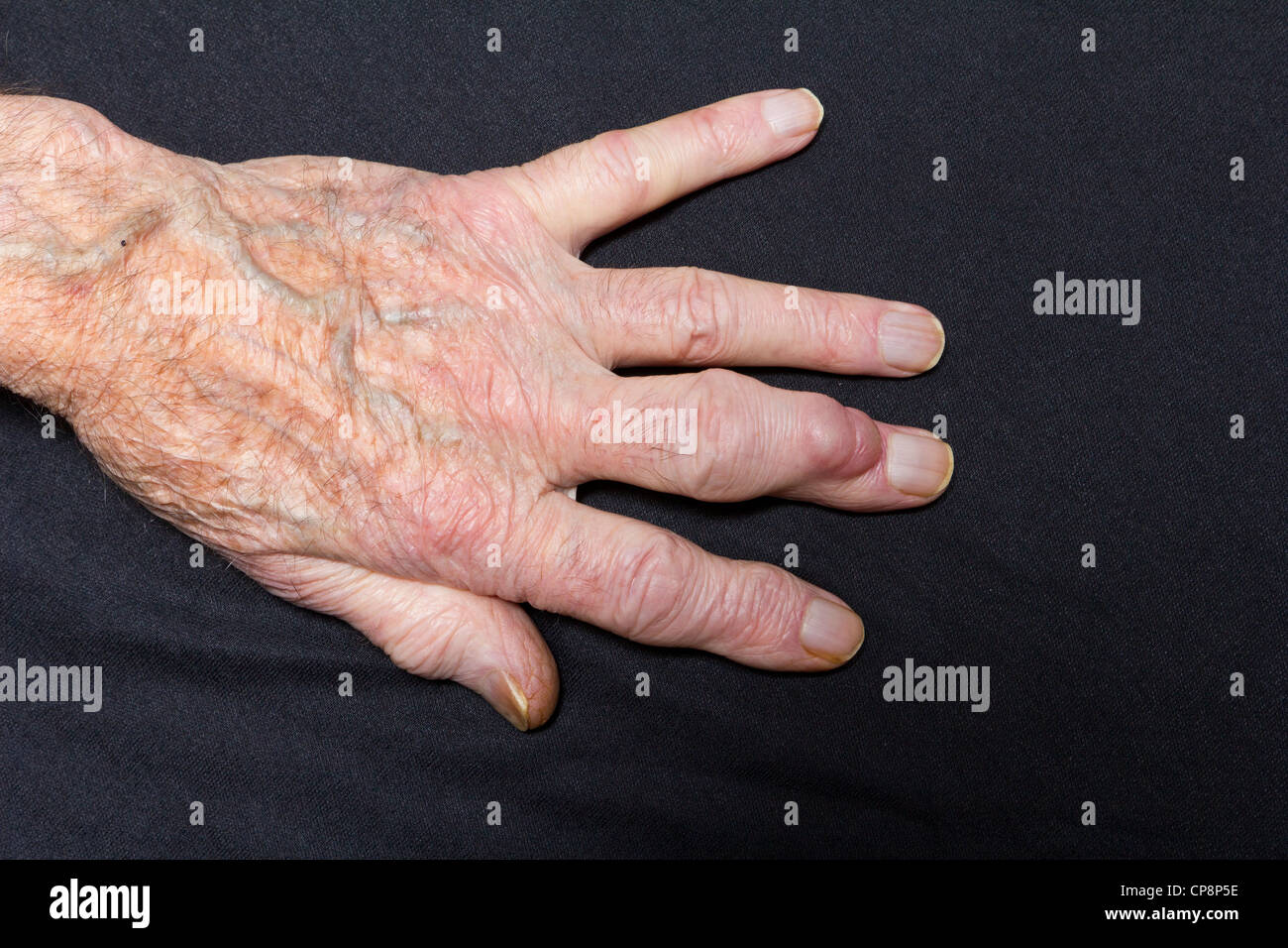 Uomo anziano con una cisti ganglio sul suo dito Foto Stock