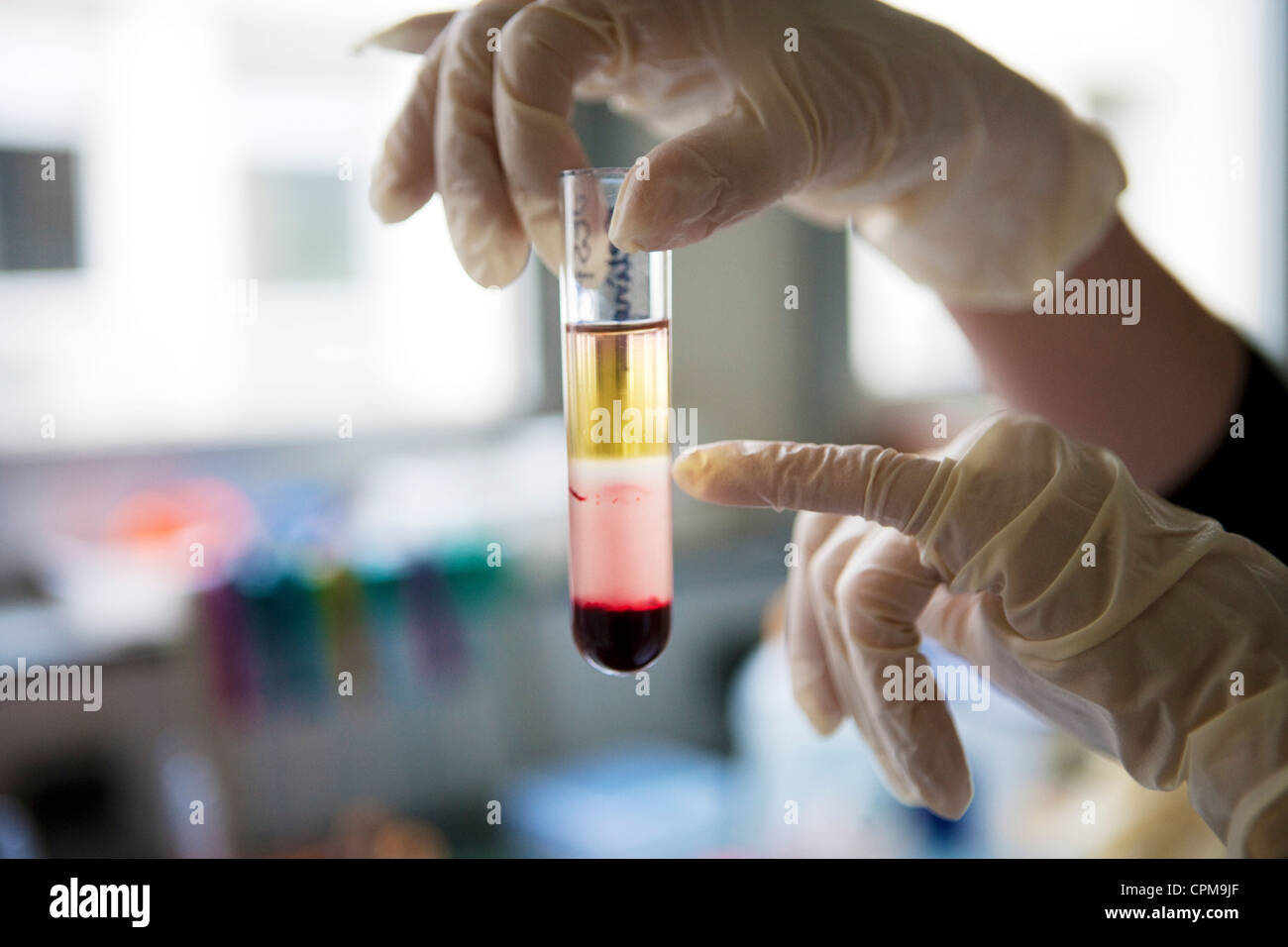 Midollo osseo donazione Foto Stock