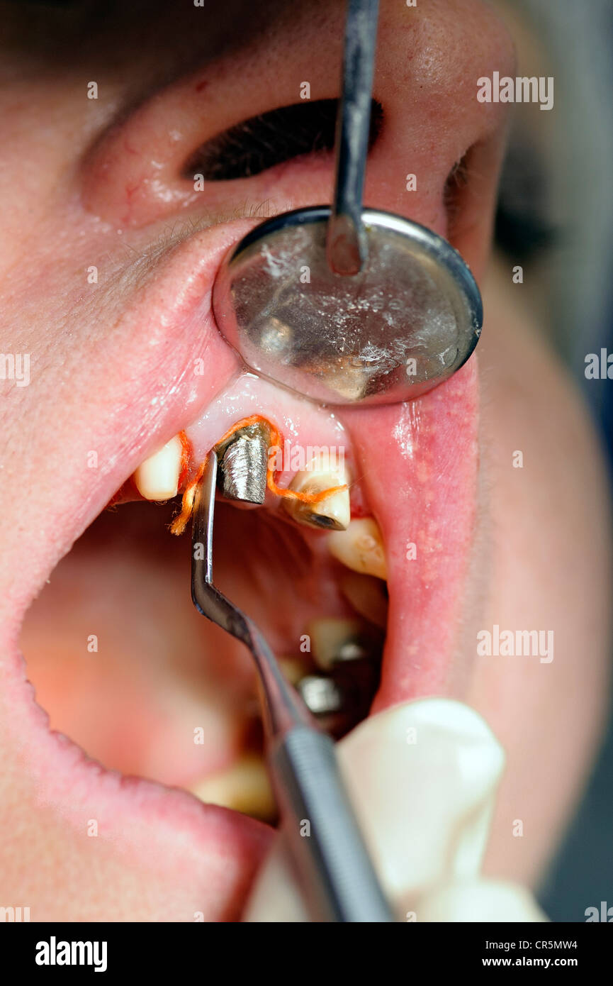 Cavo retrattile avvolto intorno il moncone di un dente durante il trattamento dentale Foto Stock