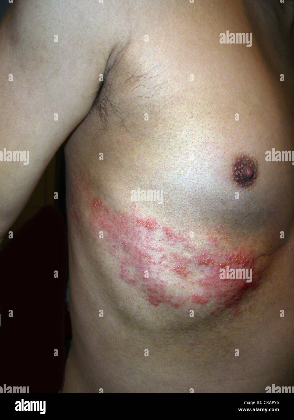 Corpo superiore di un uomo asiatico con herpes zoster, diabete Foto Stock