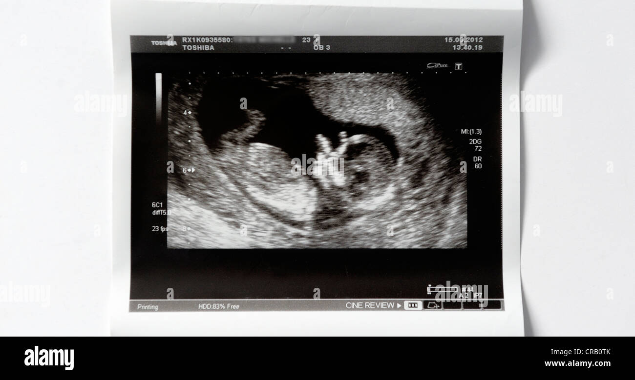 Baby scan in 13 settimane Foto Stock