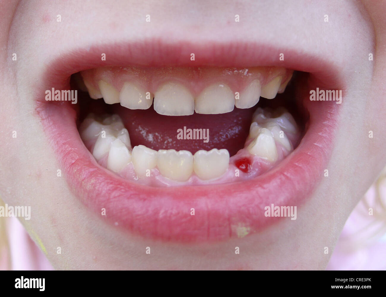 divario di dente fresca Foto Stock